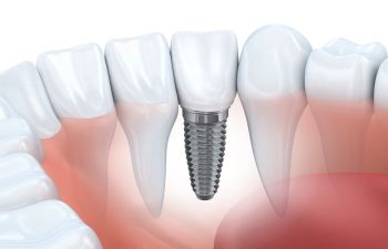 A dental implant in a patient's mouth.