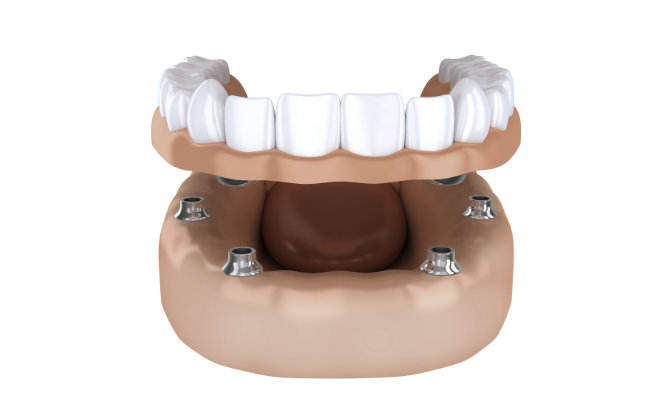 Dental Implants Marietta, GA