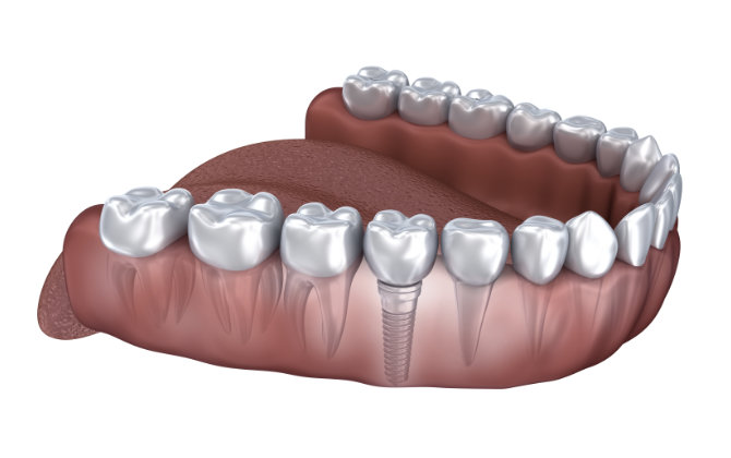 A 3d image of a dental implant in a patient's mouth.
