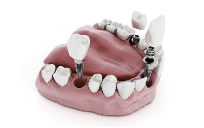 A model of a dental implant on a white background.