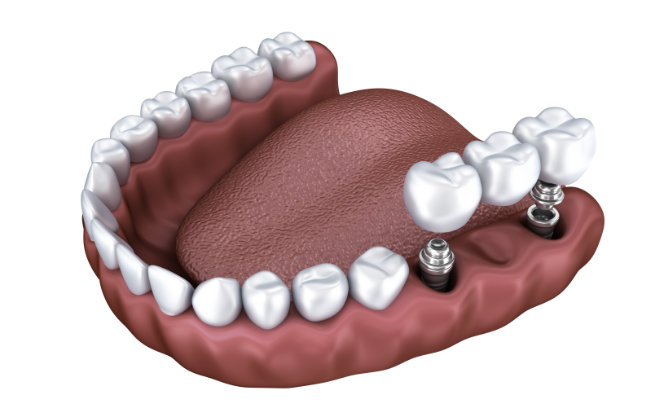 A 3d model of a tooth with dental implants.