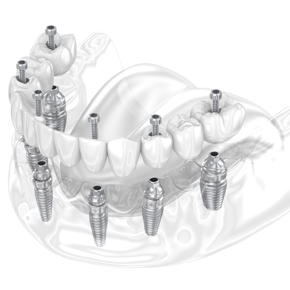 Dental prosthesis supported by six implants. Dental 3D illustration