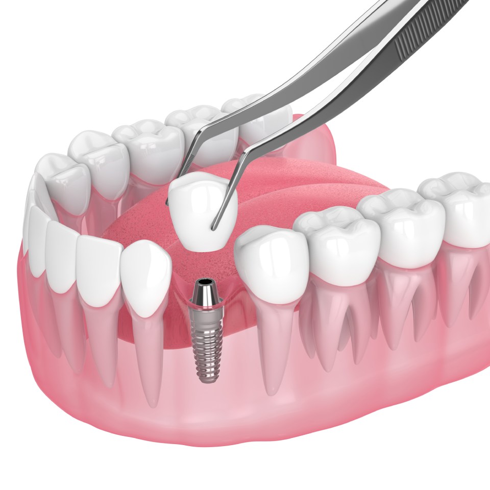 3d render of jaw with dental implant placement over white background