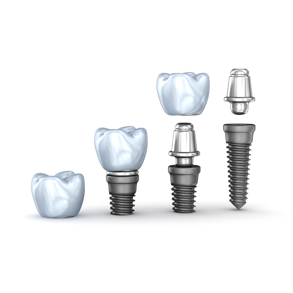 Set of dental implants isolated on white background 3D illustration