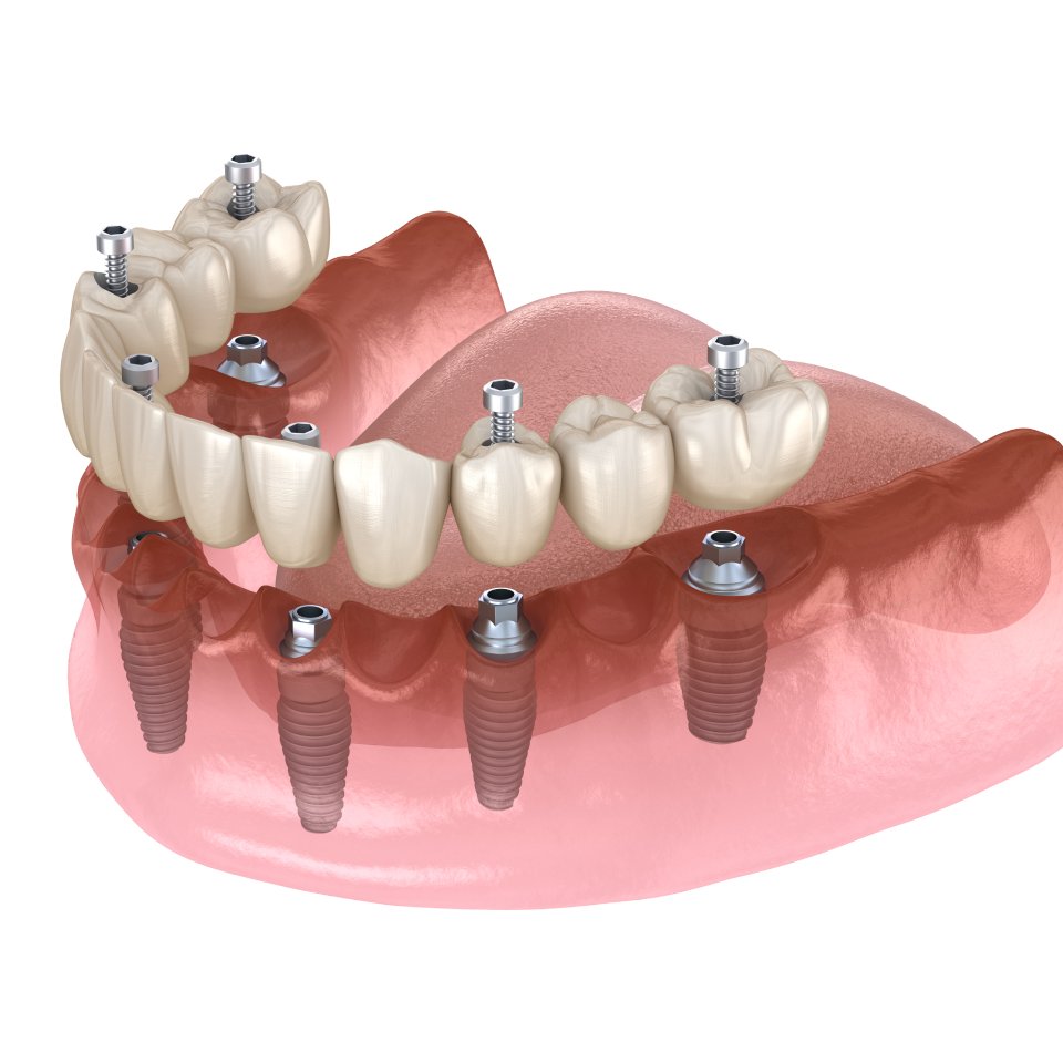 Mandibular prosthesis All on 4 system supported by implants, screw fixation. Medically accurate 3D illustration of dental concept