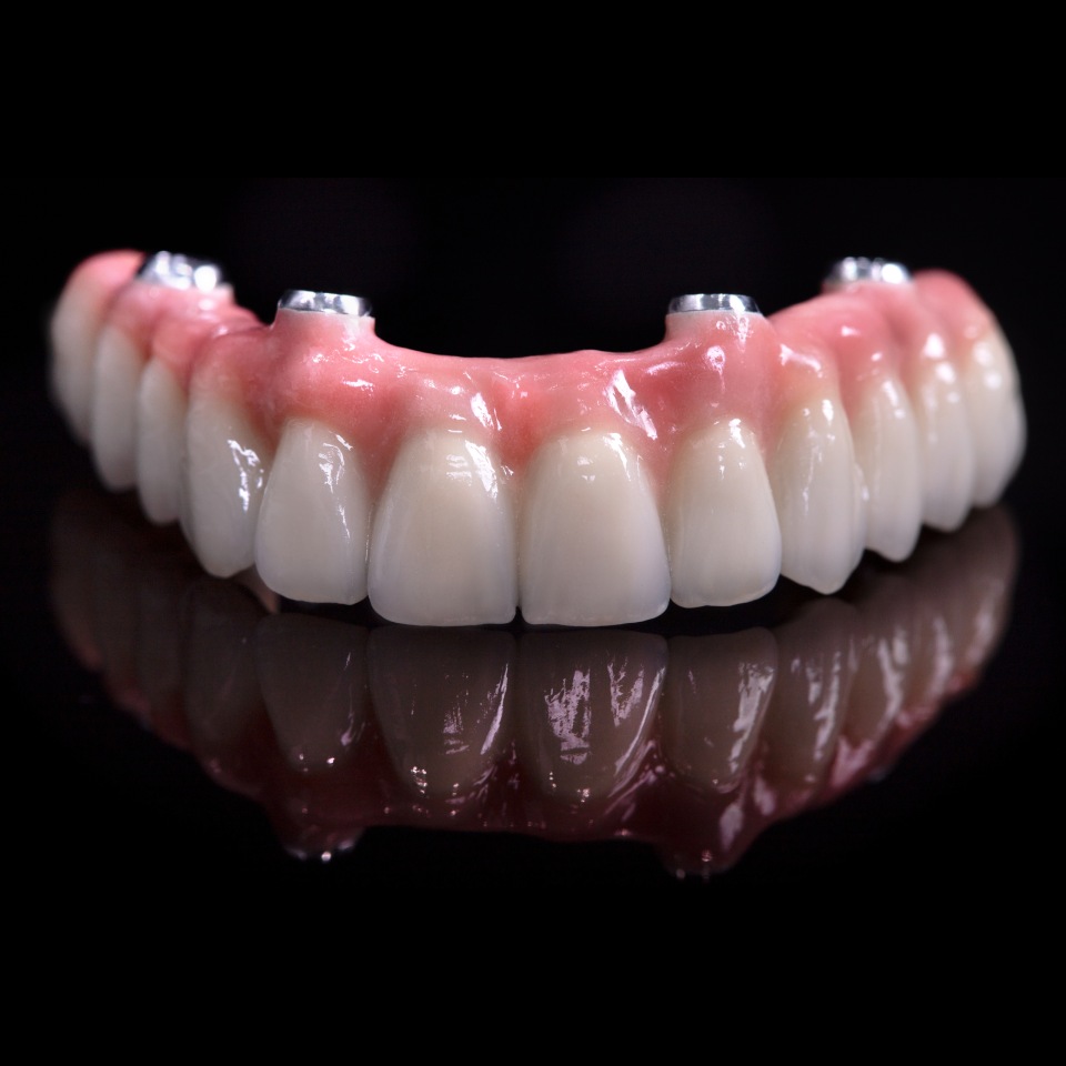 Upper zirconia full arch prosthesis with white teeth and pink anterior gums on dental implants