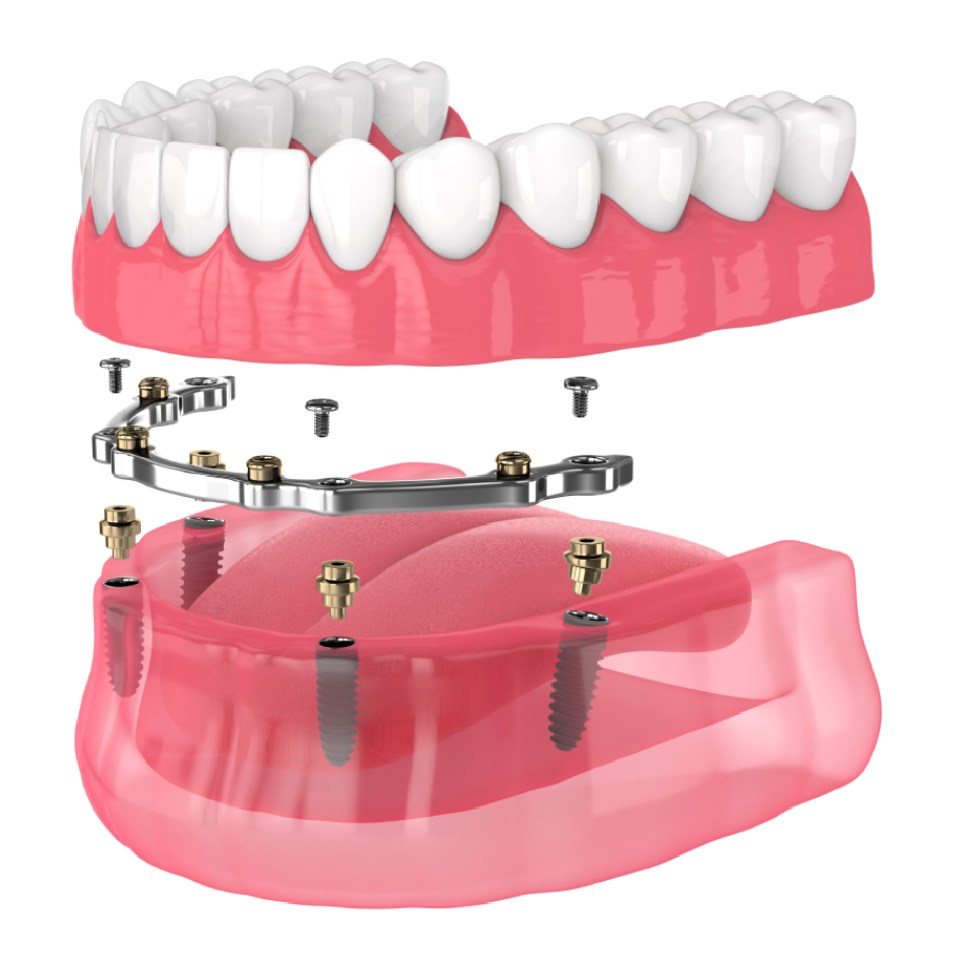 3d render of bar retained removable overdenture installation supported by implants over white backgroud