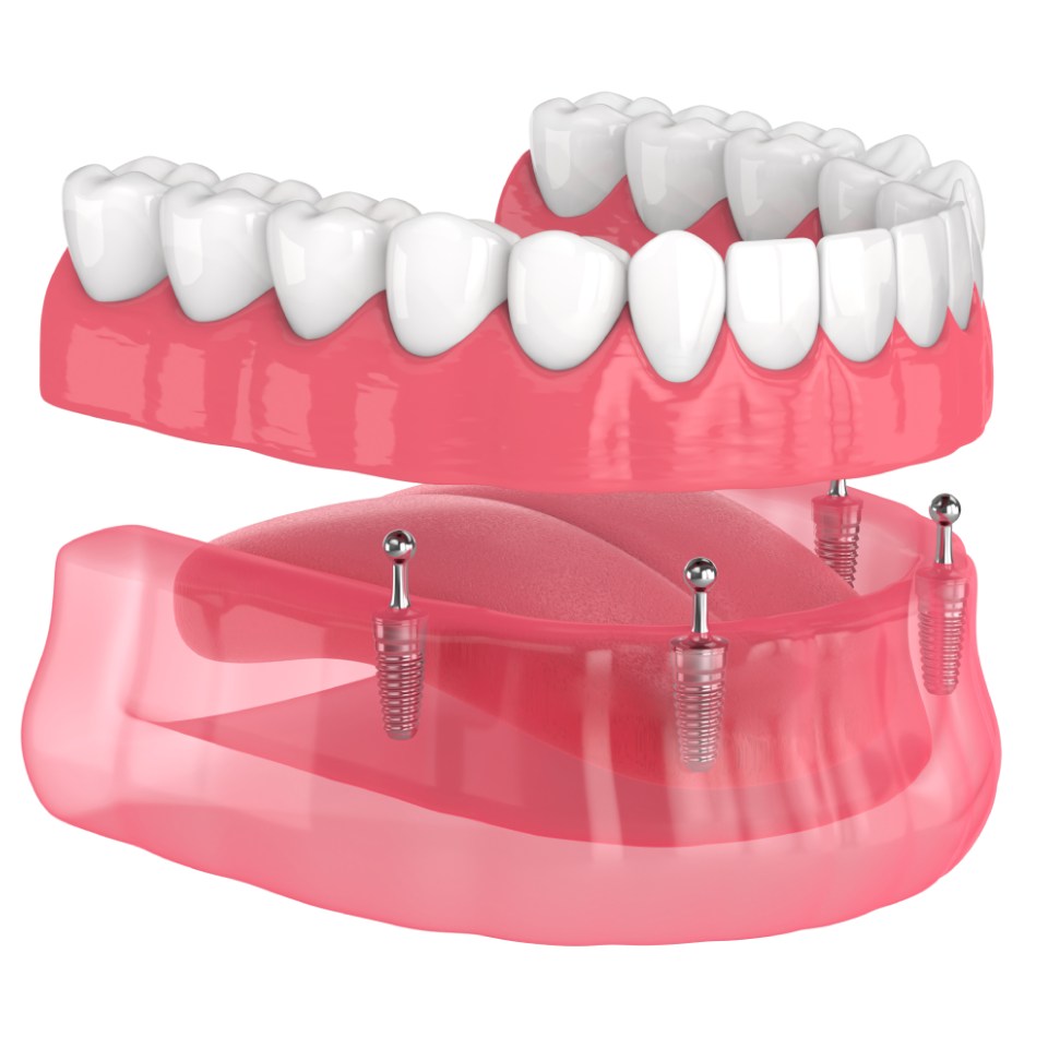 3d render of all-on-4 removable, implants supported, overdenture installation over white background