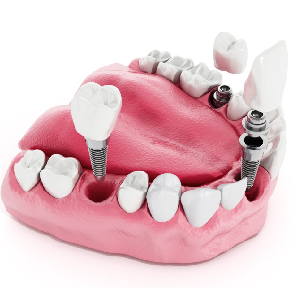 Illustration of teeth showing dental implant structure