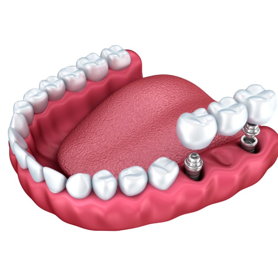 3d lower teeth and dental implant isolated on white..