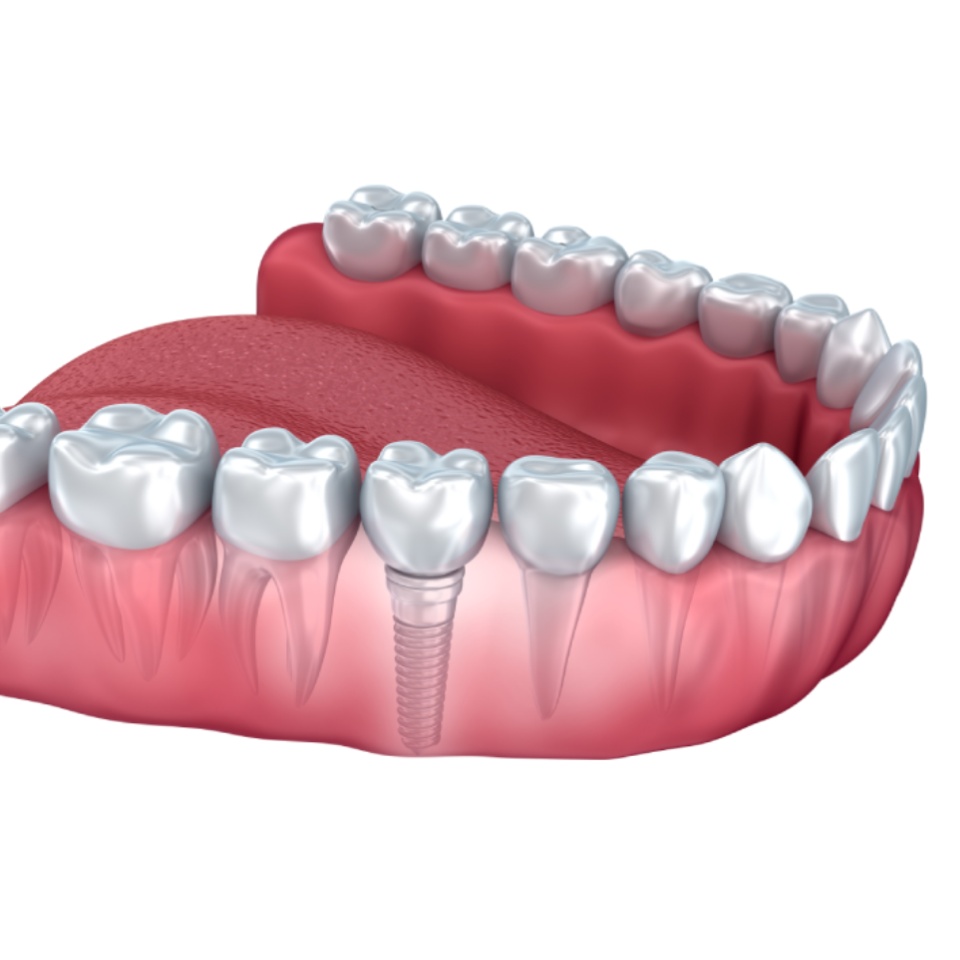 Lower teeth and dental implant transparent render isolated on white . 3D illustration