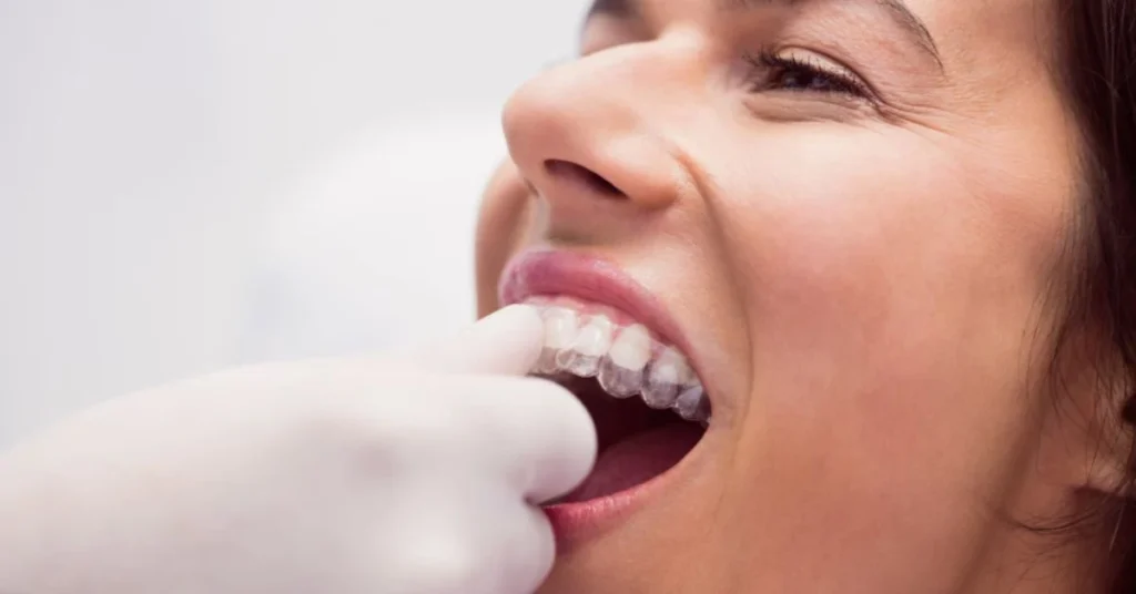 Woman fitting clear mouth guard to protect teeth from grinding