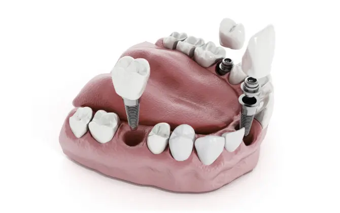 Multiple Implants