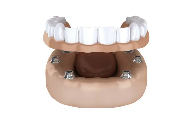 Overdentures